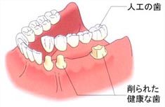 隣接する歯を支えにするブリッジの模式図