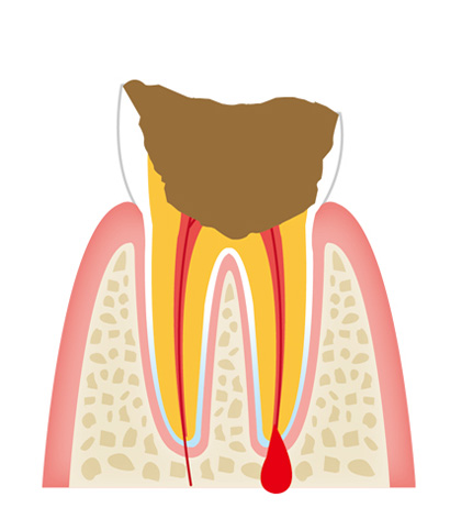 tooth4 - 一般歯科